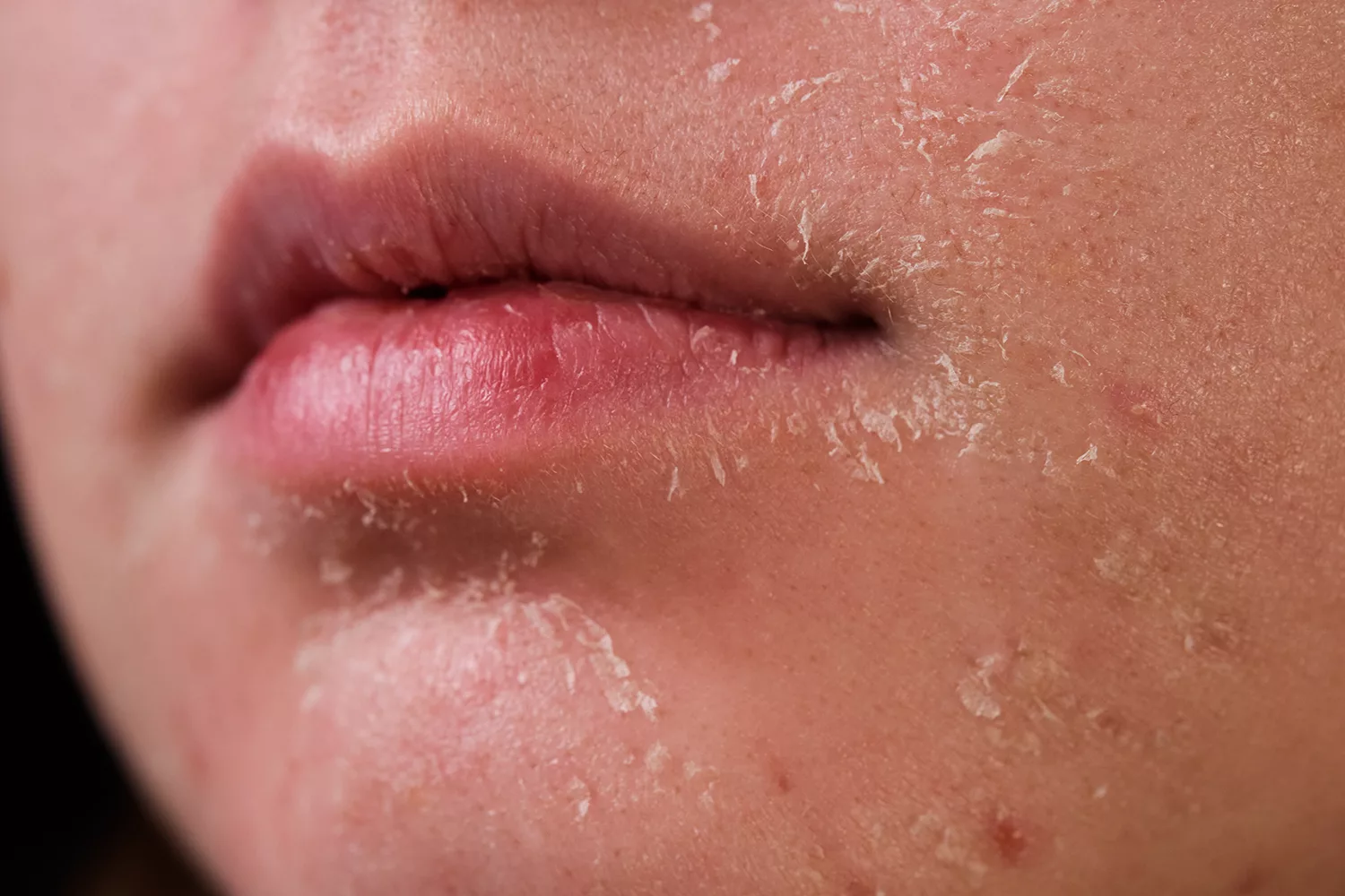 Dry-Skin